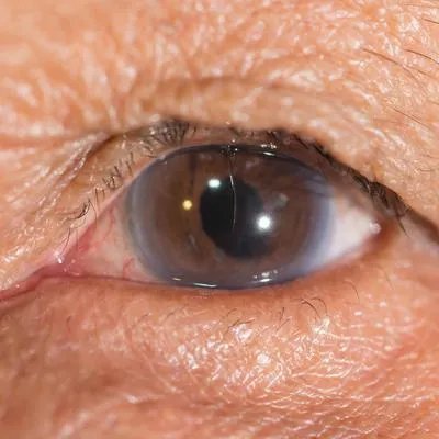 上眼皮松弛怎么恢复 揭秘上眼皮松弛的4个恢复方法