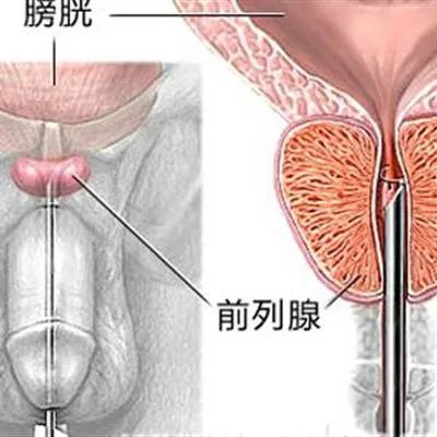 如何治疗阳痿病?