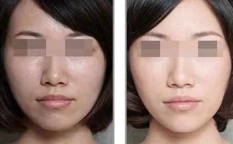 北京彩光嫩肤效果能维持多久
