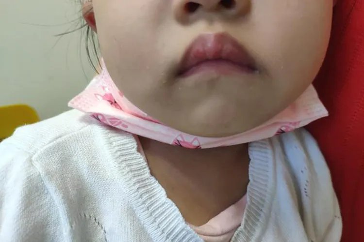 3岁娃腺样体肥大面容照片