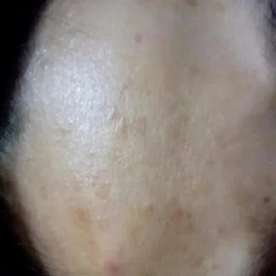 长色斑怎么可以治