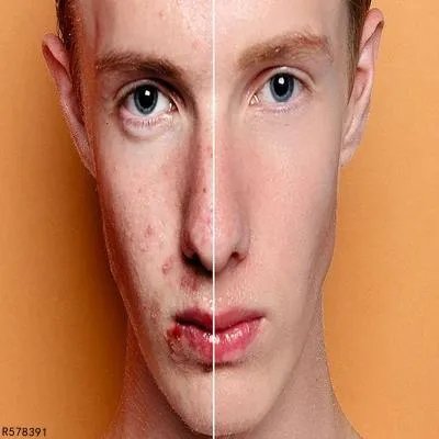 去痘坑的方法有哪些 四个方法方法去痘坑有效快速
