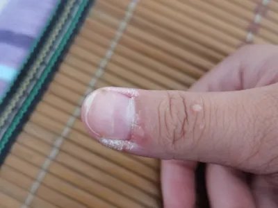 寻常疣手指甲脱屑图片