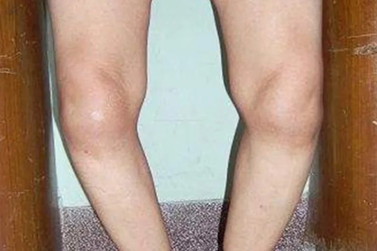 佝偻病腿型图片大全