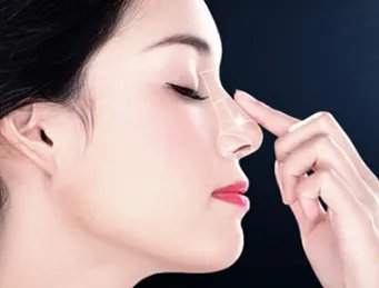 玻尿酸隆鼻瑞蓝2号维持多久
