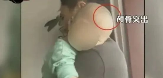 湖南郴州再现“大头娃娃”，奶粉为何屡屡出事？业内人士曝出原因