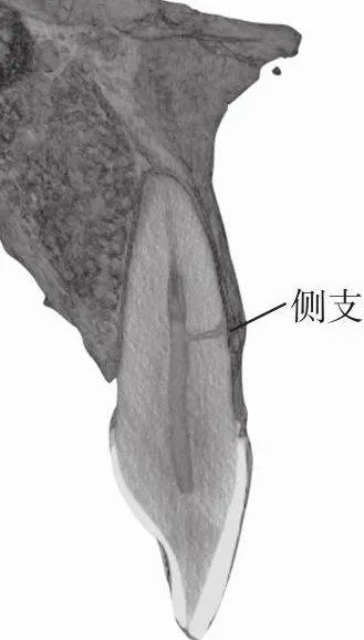 【图】牙根管系统详解