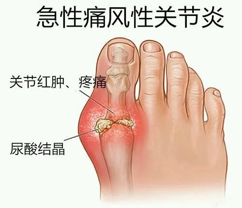 痛风