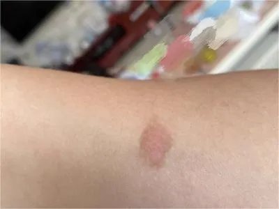 未定类型白癜风斑图片