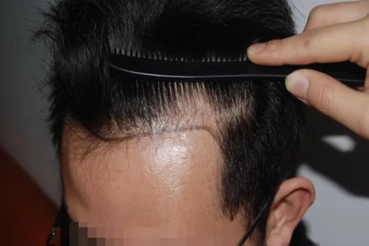 一级脱发图片