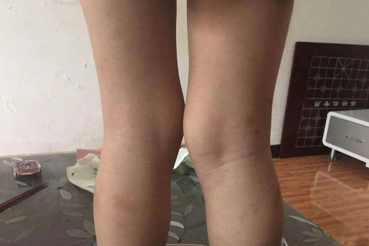 佝偻病腿型图片大全
