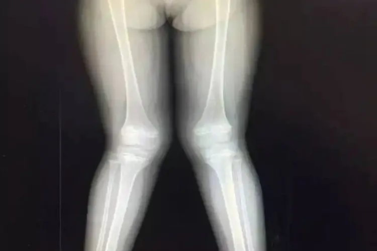 佝偻病腿型图片大全