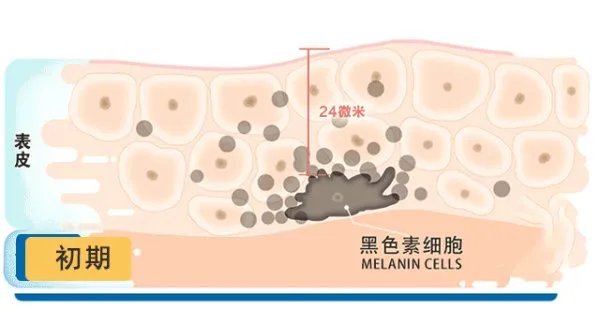 皮秒镭射和飞梭镭射可以用同一台机气吗?做过几次镭射感觉反黑特别厉