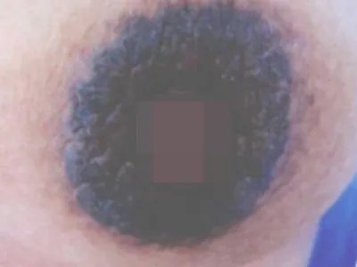 Ⅲ型乳头乳晕角化过度症乳头皮肤颜色加深图片