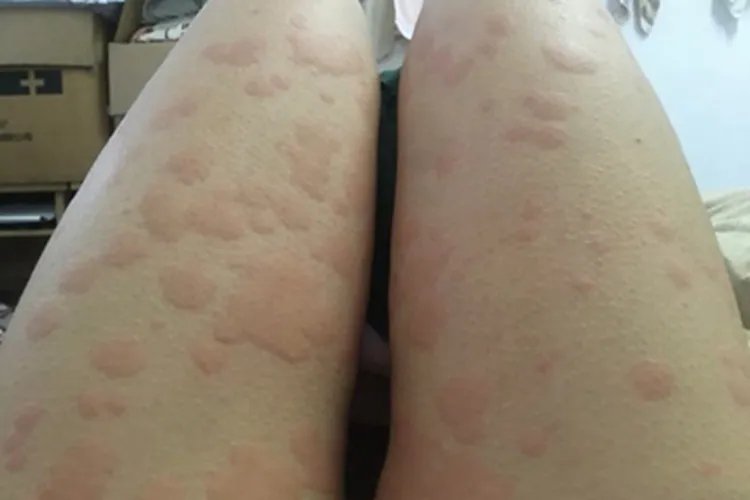 荨麻疹症状图片