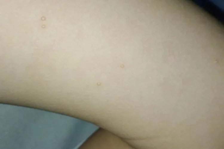 传染性软疣大腿症状图片