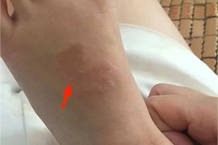环状肉芽肿脚背疙瘩图片