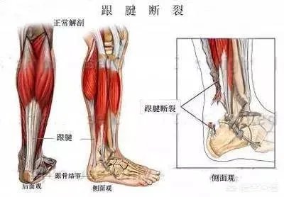 还原受伤过程!考辛斯跟腱完全撕裂,是火箭球员的故意犯规吗?