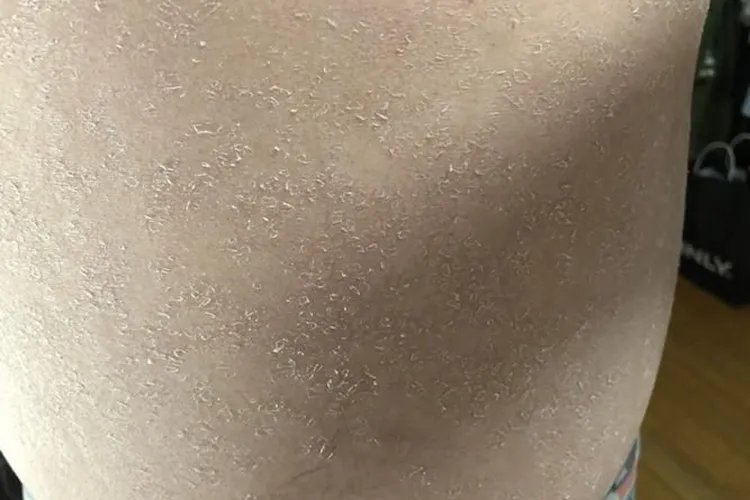 女人小腹肚皮起皮屑图片