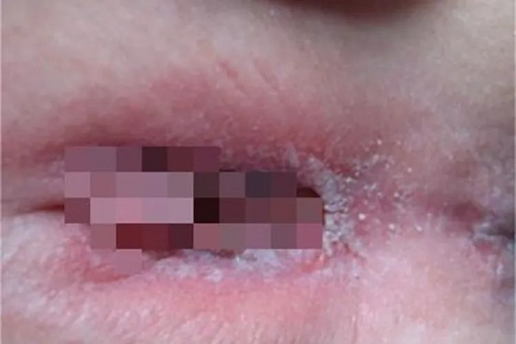 外阴阴道念珠菌病会阴部红肿图片