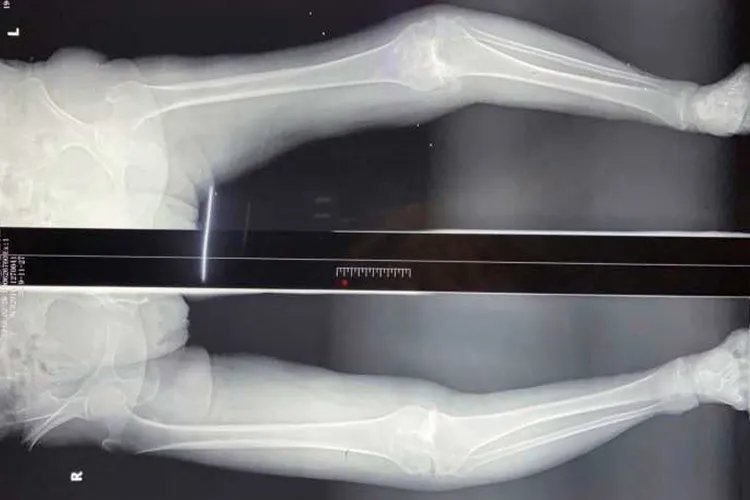 佝偻病腿型图片大全