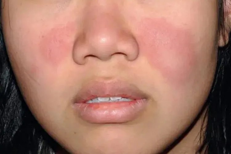 女性面部过敏症状图片