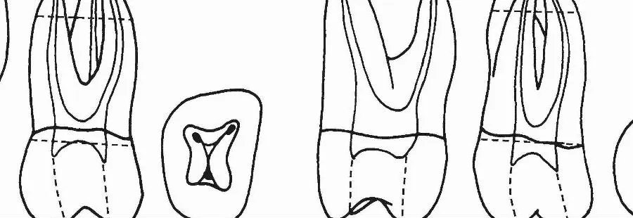 【图】牙根管系统详解