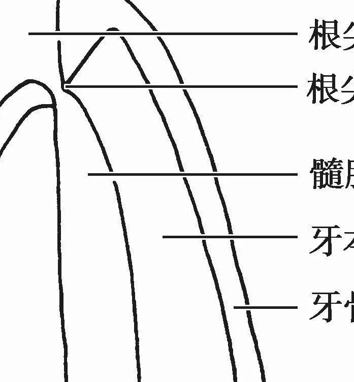 【图】牙根管系统详解