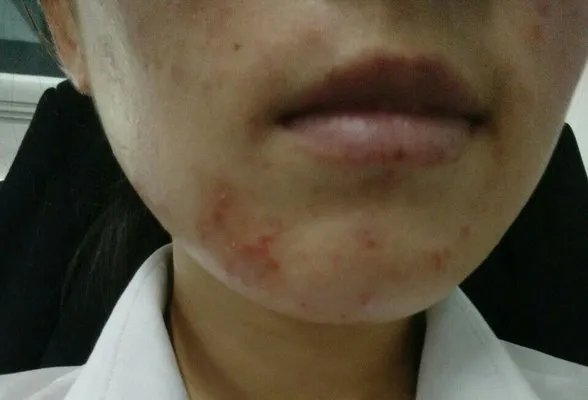 脸上痤疮是什么原因?