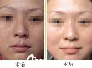 彩光嫩肤祛斑效果如何