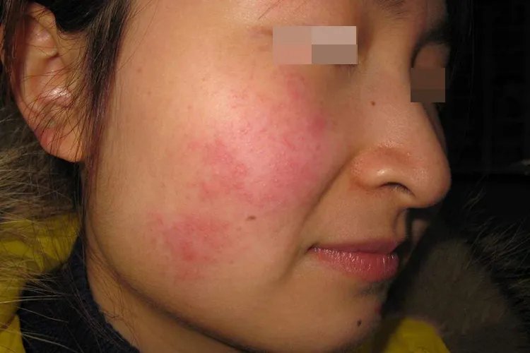 女性面部过敏症状图片