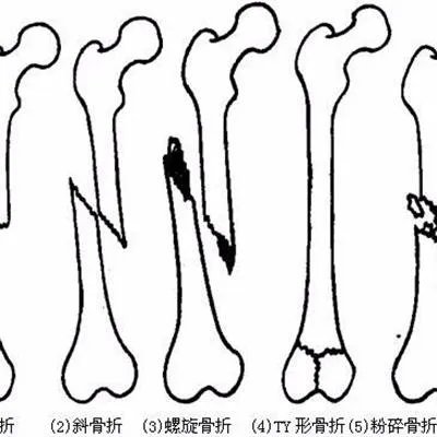 股骨头怎么治疗