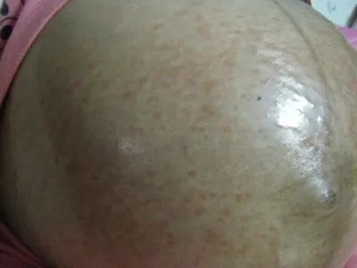 妊娠多形疹丘疹图片