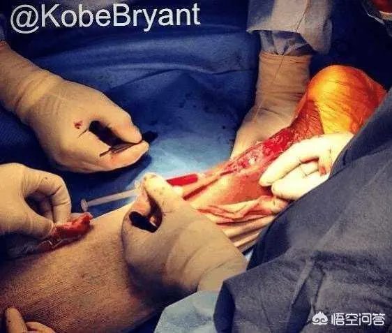 还原受伤过程!考辛斯跟腱完全撕裂,是火箭球员的故意犯规吗?