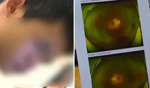 少年近视2400度什么情况:年仅15岁背后原因惊呆了