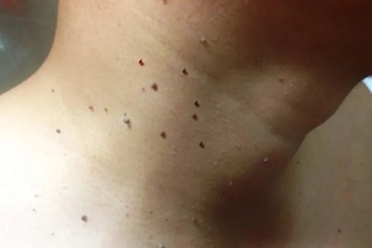 脖子上长小肉疙瘩图片